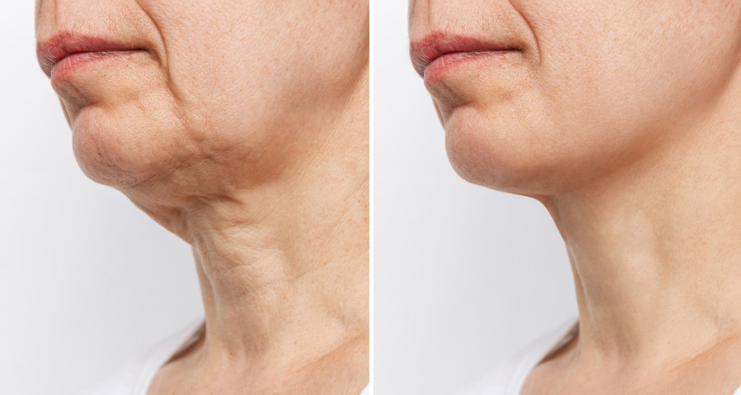 Результаты SMAS-подтяжки по технологии Мендельсона